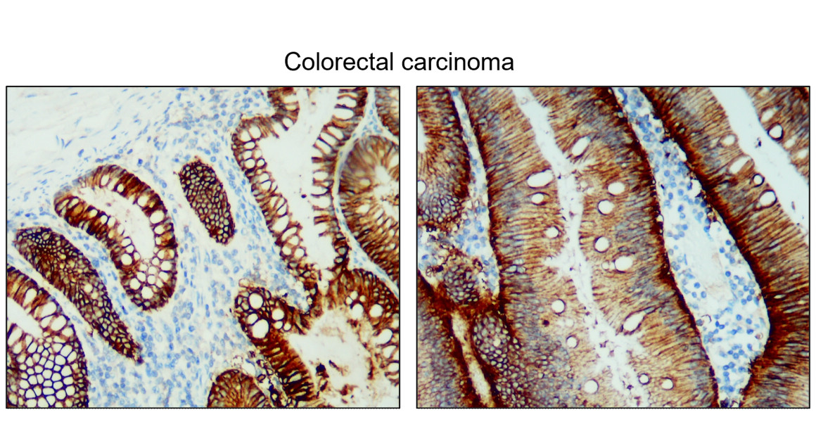 IR218-1 anti- EpCAM antibody IHC image IR218-1 anti- EpCAM antibody IHC image