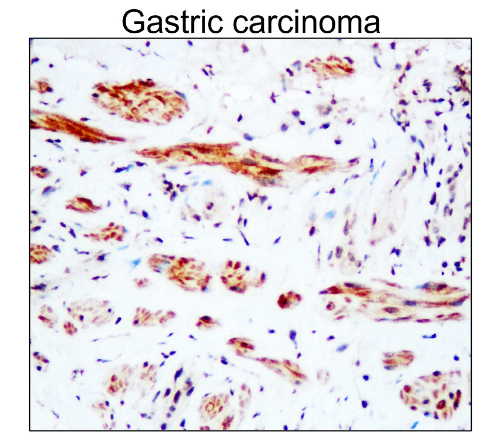 IR101-421抗PARP裂解抗體_胃癌IHC圖像