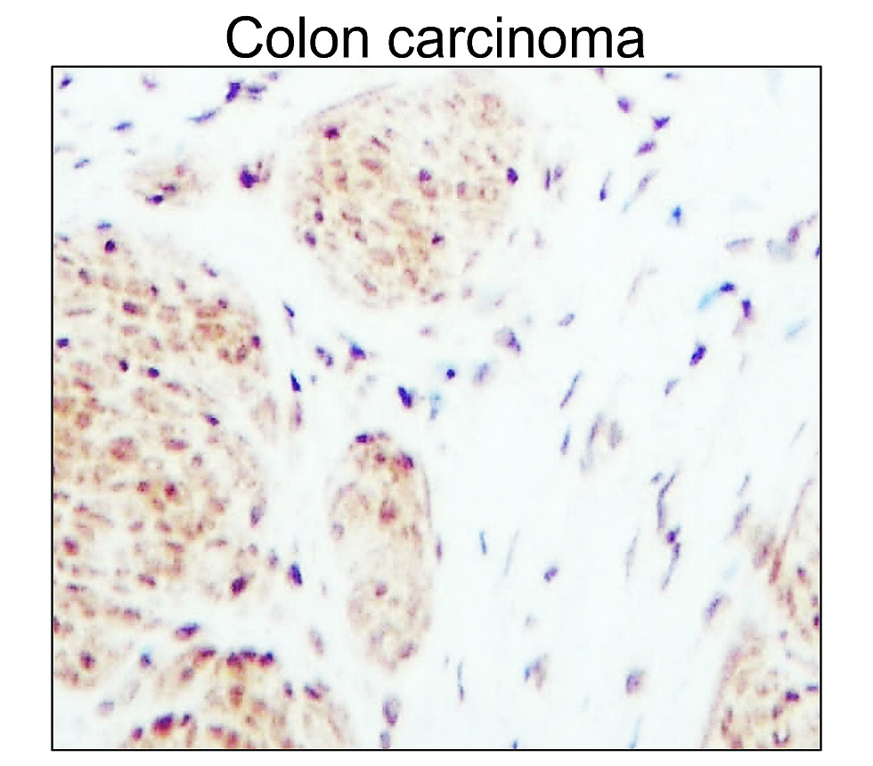 IR101-421抗PARP裂解抗體_結腸癌IHC圖像