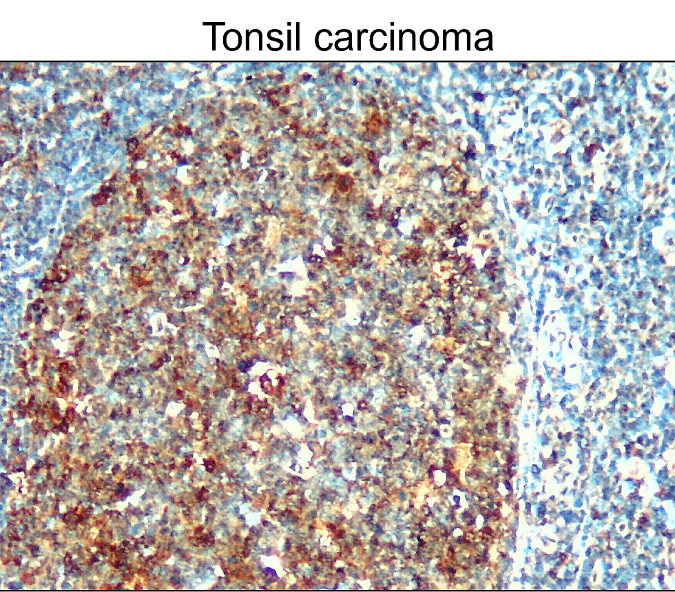 IR102-426 anti-Survivin / BIRC5 antibody_Tonsil carcinoma IHC image IR102-426 anti-Survivin / BIRC5 antibody_Tonsil carcinoma IHC image