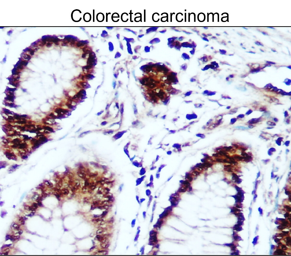 IR102-426 anti-Survivin / BIRC5 antibody_Colorectal carcinoma IHC image IR102-426 anti-Survivin / BIRC5 antibody_Colorectal carcinoma IHC image