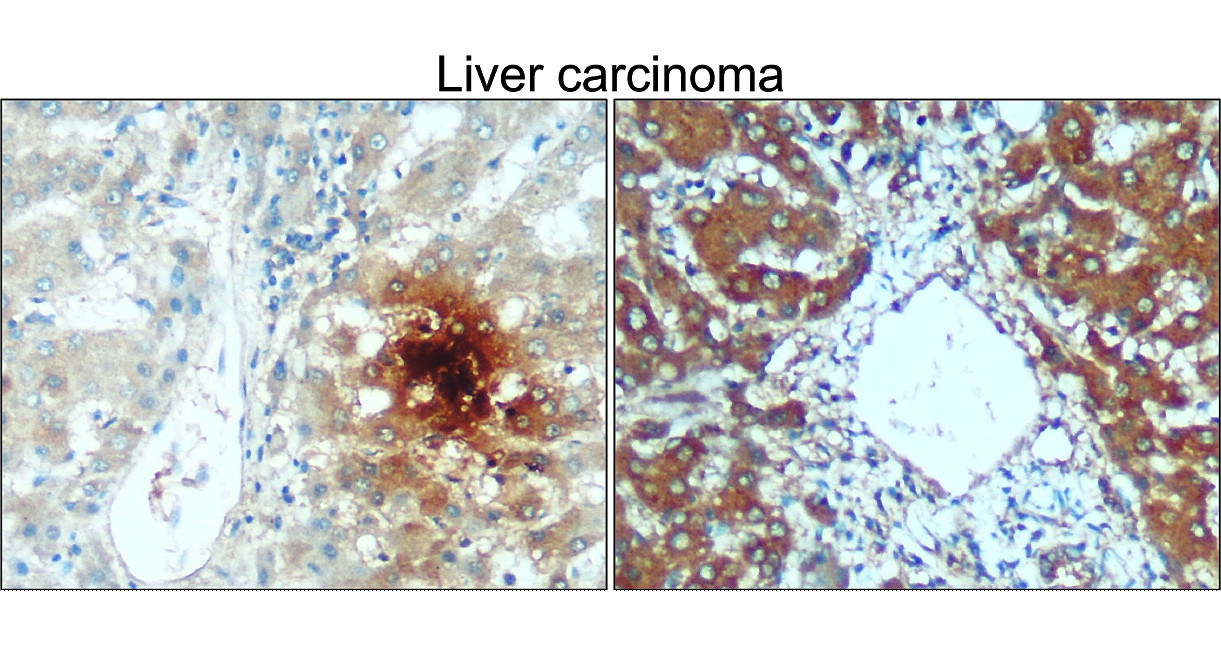 IR106-P2 anti-TNF alpha antibody_Liver carcinoma IHC image IR106-P2 anti-TNF alpha antibody_Liver carcinoma IHC image