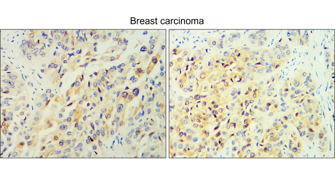 IR112-457 anti TGF beta 1 antibody_Breast carcinoma IHC image