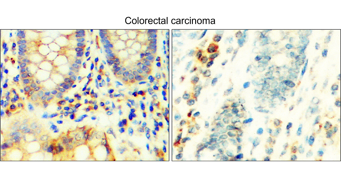 IR112-457 anti TGF beta 1 antibody_Colorectal carcinoma IHC image