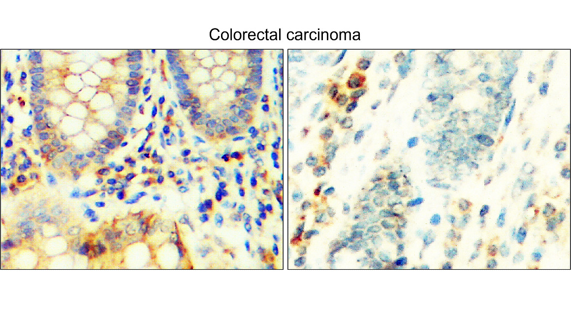 IR112-457 anti TGF beta 1 antibody_Colorectal carcinoma IHC image