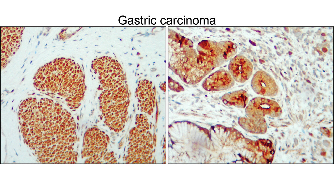 IR115-286 anti-Cyclin A2 antibody_Gastric carcinoma IHC image IR115-286 anti-Cyclin A2 antibody_Gastric carcinoma IHC image