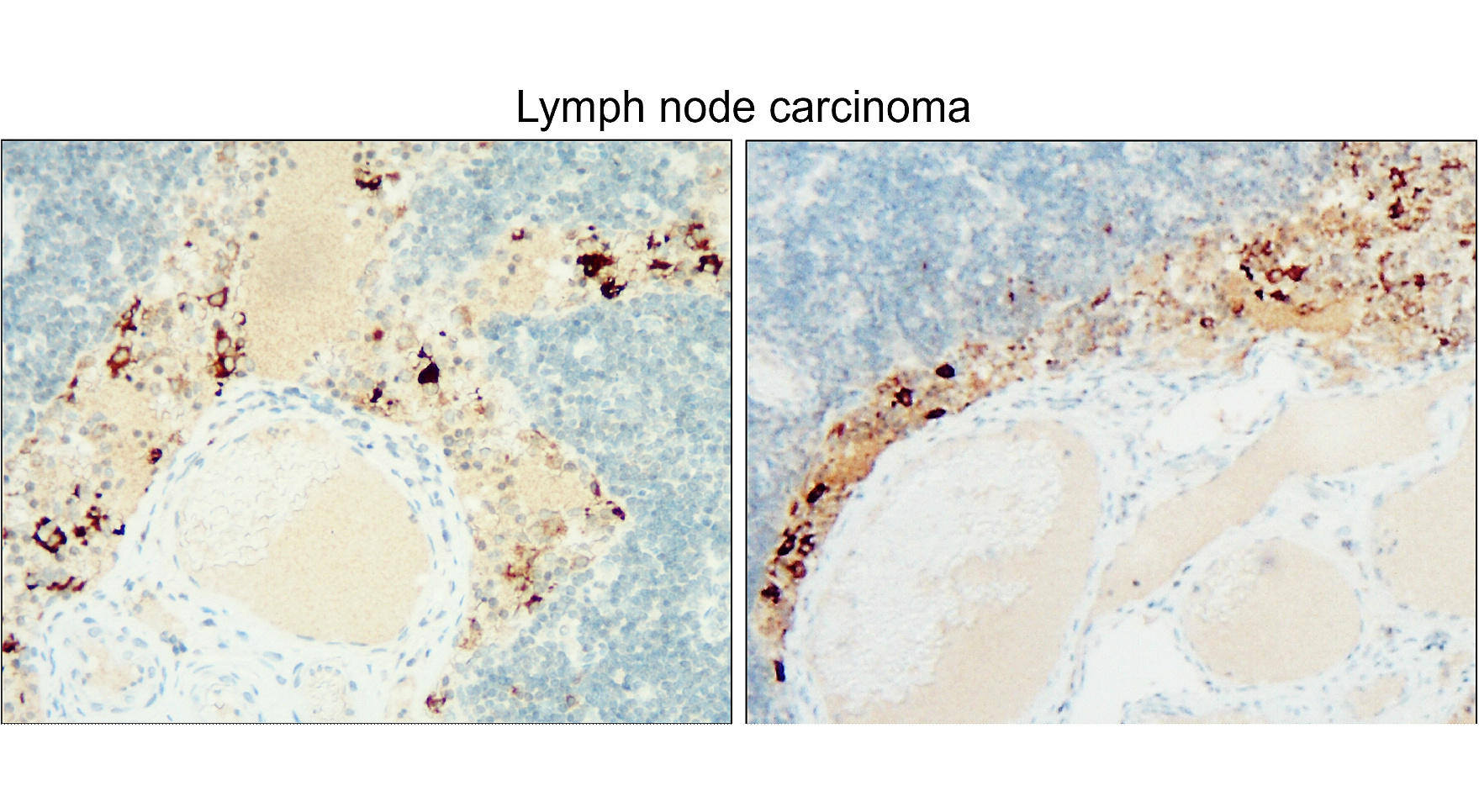 IR30-78 anti- CD133 / Prominin-1 antibody_Lymph node carcinoma IHC image IR30-78 anti- CD133 / Prominin-1 antibody_Lymph node carcinoma IHC image