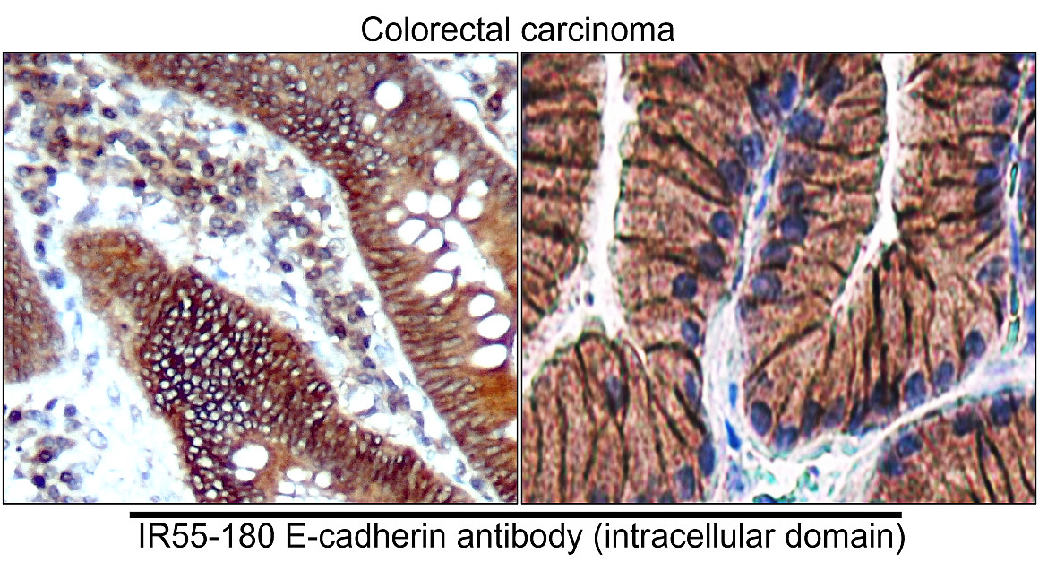 Customer feedback Image IR55-180 anti-E cadherin antibody IHC image
