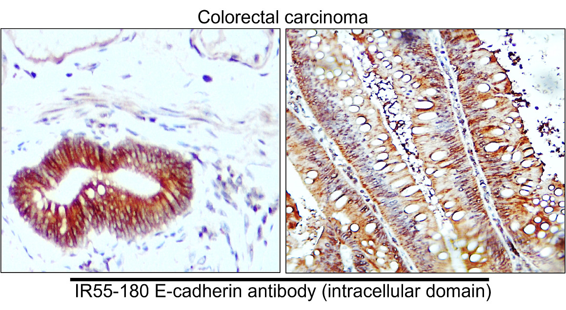 Customer feedback Image IR55-180 anti-E cadherin antibody IHC image