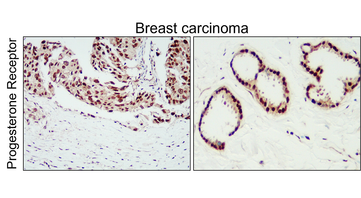 IR215-787 anti- Progesterone Receptor antibody IHC image IR215-787 anti- Progesterone Receptor antibody IHC image