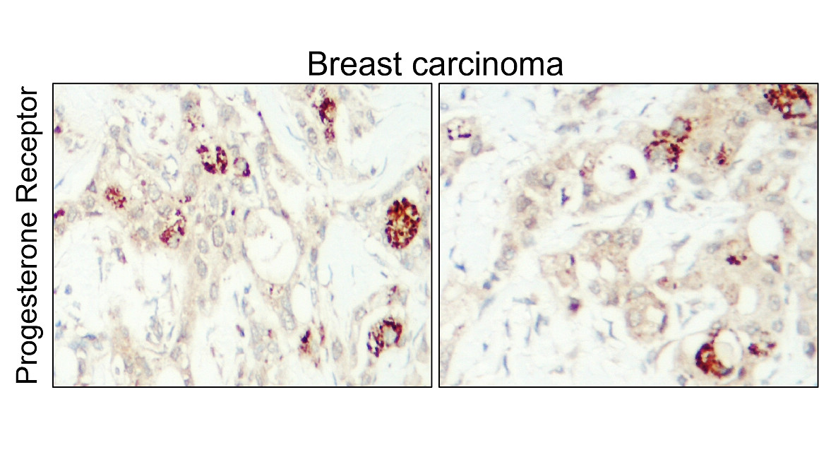 IR215-787 anti- Progesterone Receptor antibody IHC image IR215-787 anti- Progesterone Receptor antibody IHC image