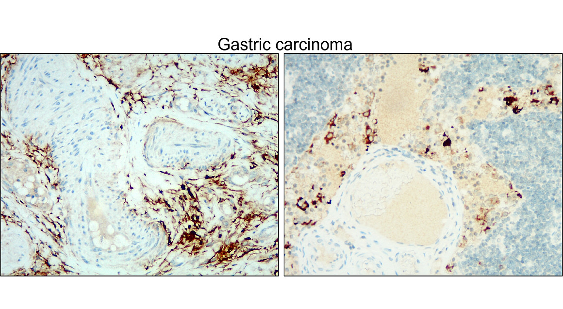 IR30-78 anti- CD133 / Prominin-1 antibody_Castric carcinoma IHC image IR30-78 anti- CD133 / Prominin-1 antibody_Castric carcinoma IHC image