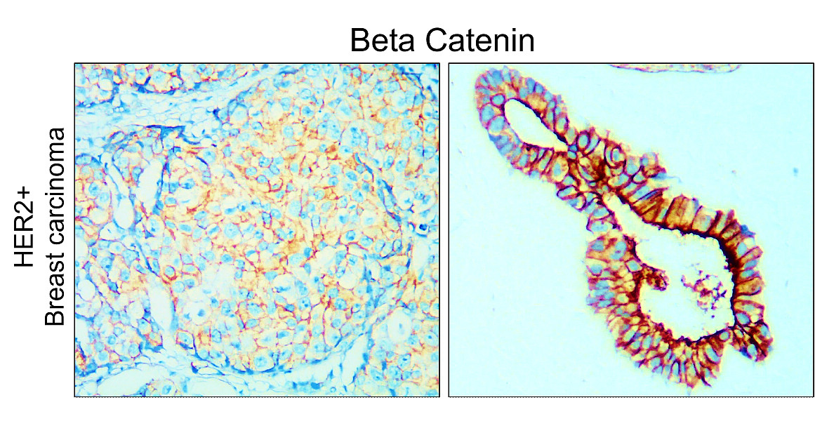 IR49-149 anti-Beta Catenin antibody_HER2+ Breast carcinoma IHC image