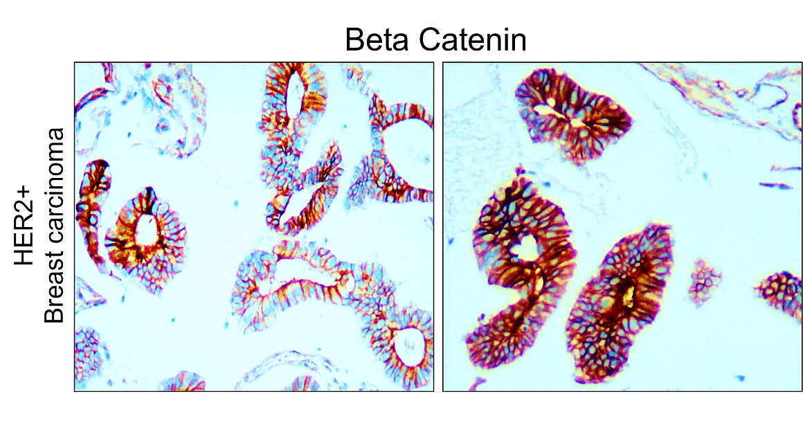 IR49-149 anti-Beta Catenin antibody_HER2+ Breast carcinoma IHC image