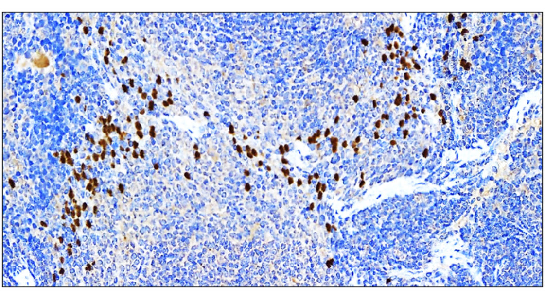 IR91-384 anti-SQSTM1 / p62 antibody IHC image IR91-384 anti-SQSTM1 / p62 antibody IHC image