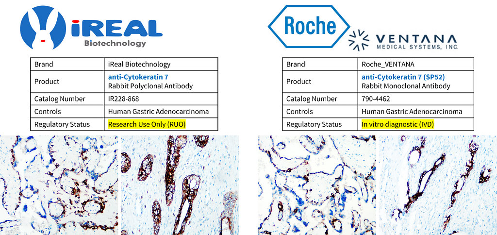 IR228-868 anti-Cytokeratin 7 antibody IHC image IR228-868 anti-Cytokeratin 7 antibody IHC image