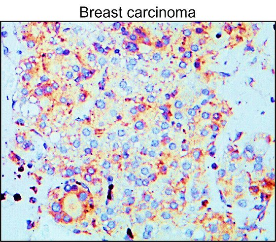IR70-234 anti-MMP9 antibody_Breast carcinoma IHC image