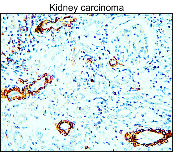 IR70-234 anti-MMP9 antibody_Kidney carcinoma IHC image