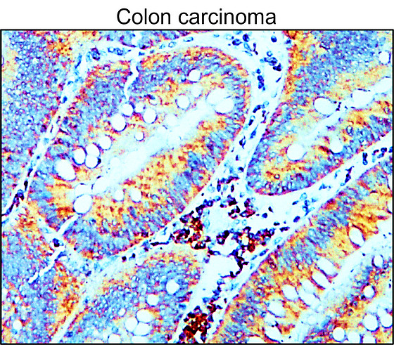 IR70-234 anti-MMP9 antibody_Colon carcinoma IHC image