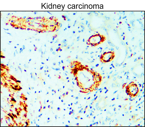 IR70-234 anti-MMP9 antibody_Kidney carcinoma IHC image
