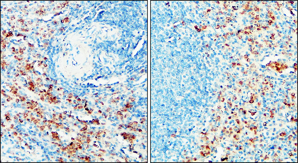 IR291-959 anti IRF-4 / MUM1 antibody_Human tonsil cancer tissue IHC image IR291-959 anti IRF-4 / MUM1 antibody_Human tonsil cancer tissue IHC image