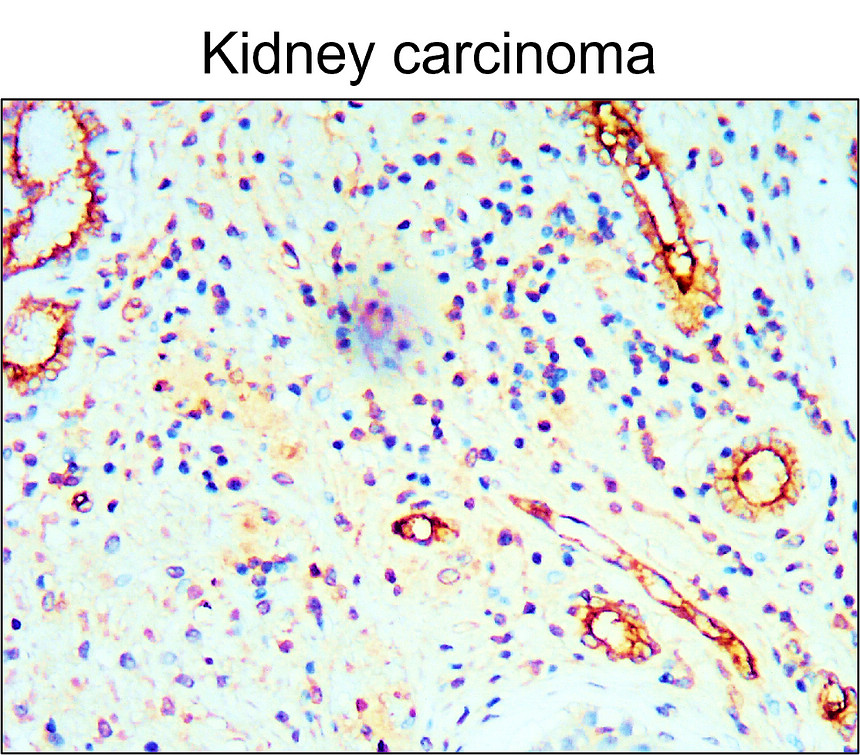 IR76-259 anti-CD34 antibody_Kidney carcinoma IHC image