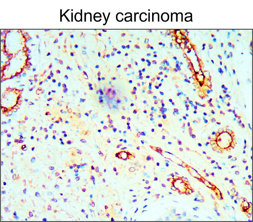 IR76-259 anti-CD34 antibody_Kidney carcinoma IHC image IR76-259 anti-CD34 antibody_Kidney carcinoma IHC image