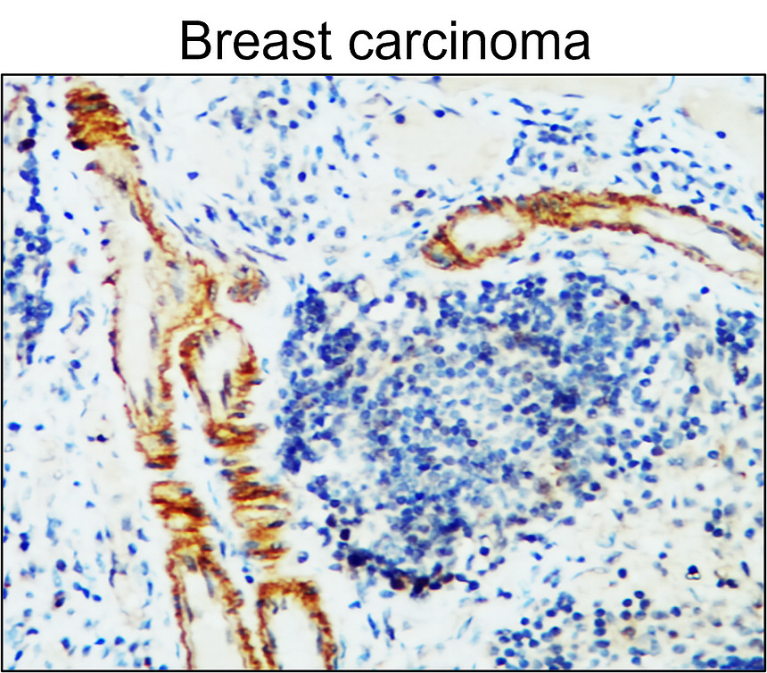IR79-272 anti-VCAM-1 / CD106 antibody_Breast carcinoma IHC image IR79-272 anti-VCAM-1 / CD106 antibody_Breast carcinoma IHC image