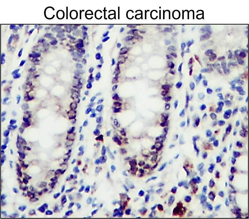 IR79-272 anti-VCAM-1 / CD106 antibody_Colorectal carcinoma IHC image