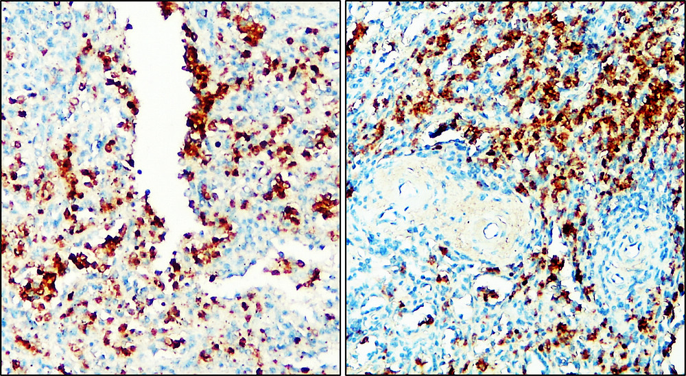 IR329-1034 Toll-like Receptor 9 / TLR9 antibody_Human tonsil cancer tissue IHC image
