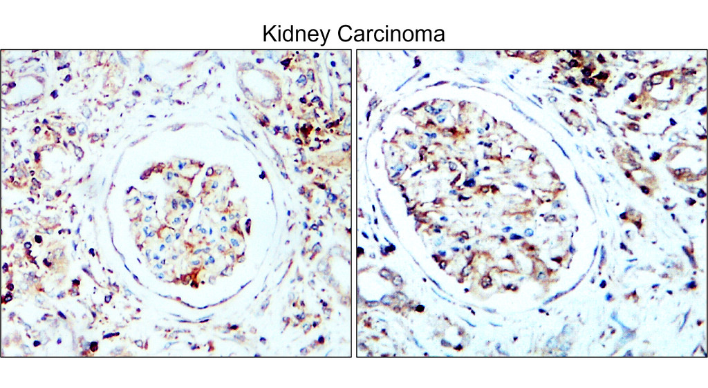 IR84-366 anti-LC3B antibody_Kidney Carcinoma IHC image 