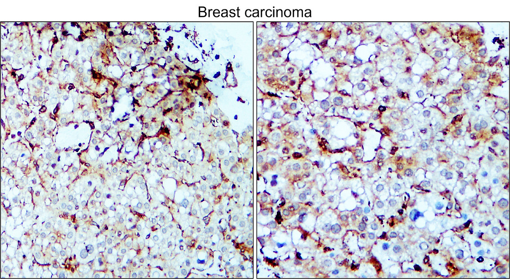 IR108-442 anti-VEGF antibody_Breast carcinoma IHC image IR108-442 anti-VEGF antibody_Breast carcinoma IHC image