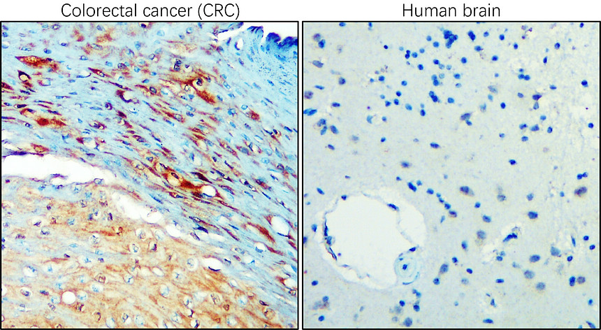 IR111-456 anti-Carbonic Anhydrase IX / CA-IX antibody IHC image IR111-456 anti-Carbonic Anhydrase IX / CA-IX antibody IHC image