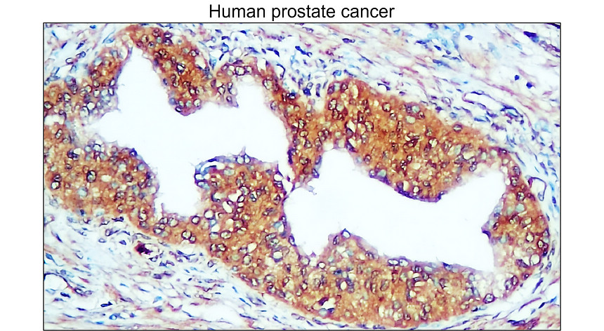 IR111-456 anti-Carbonic Anhydrase IX / CA-IX antibody IHC image IR111-456 anti-Carbonic Anhydrase IX / CA-IX antibody IHC image